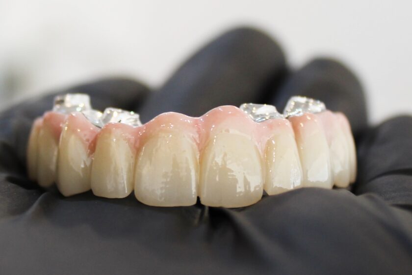 Lucrare all on definitivă cu structură Titan frezat +gingie ceramică 4 (1)