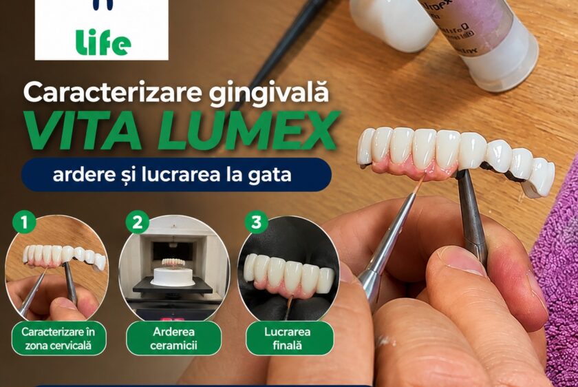 Caracterizare cu gingie în zona cervicală cu vita lumex , ardere și lucrarea la gata