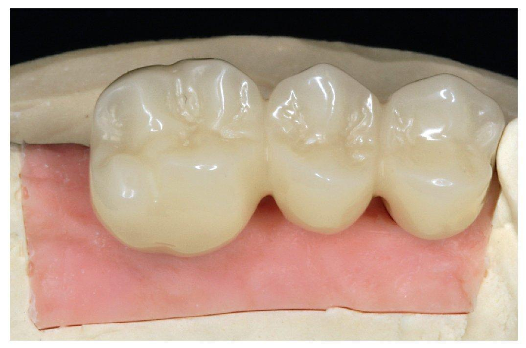 PMMA de Lunga Durata – Lucrari Dentare _ ToothLife