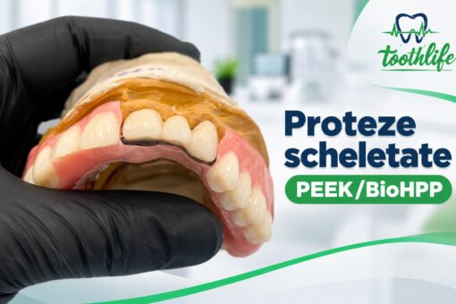 proteze scheletate parțiale cu schelet din PEEKBioHPP frezate
